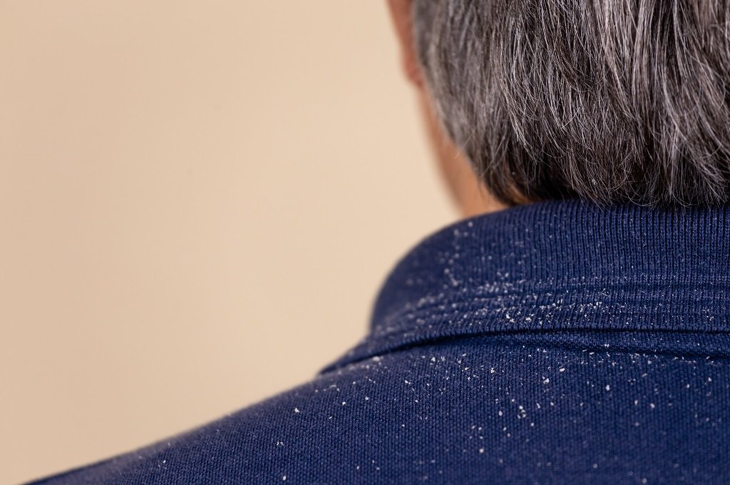 5 Quick Tips For Getting Rid Of Dandruff Fast!
